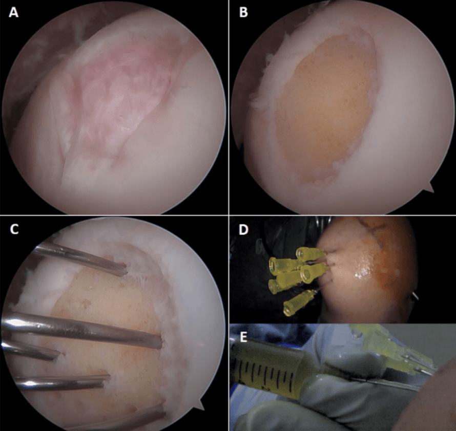 arthroscopic-technique.png arthroscopic-technique.png