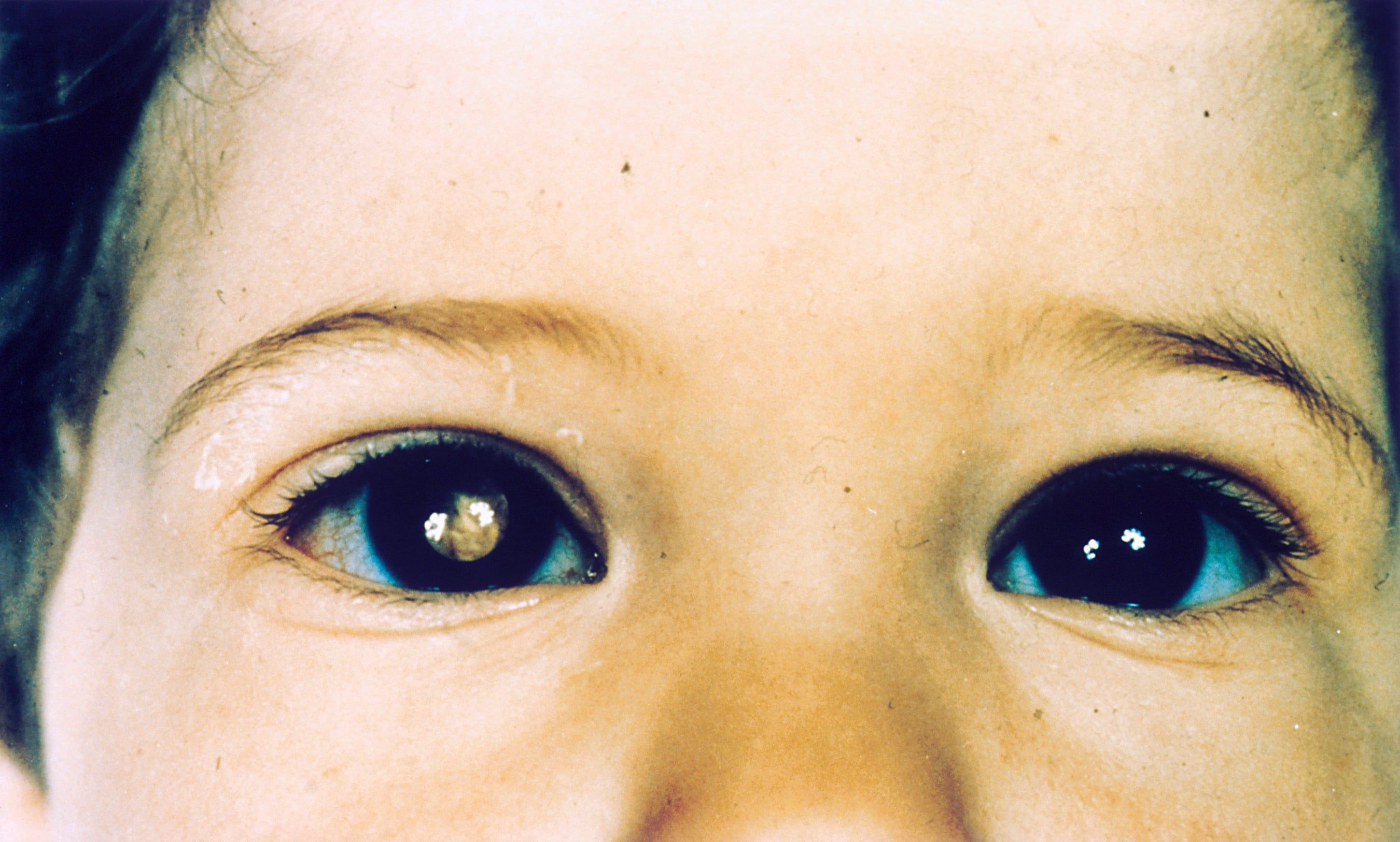 Retinoblastoma.jpg