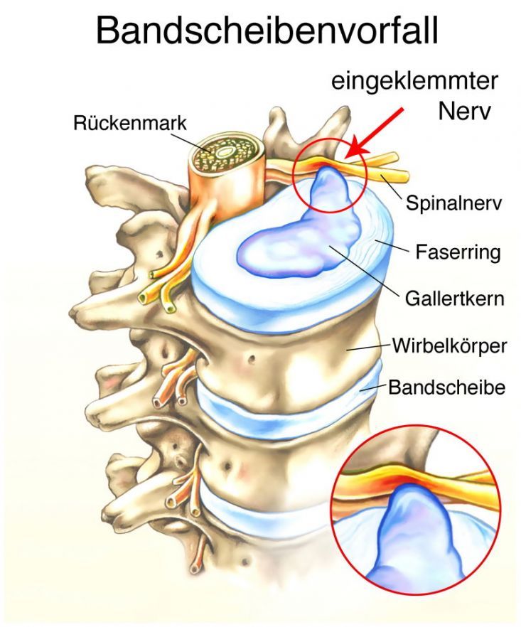 Bandscheibenvorfall