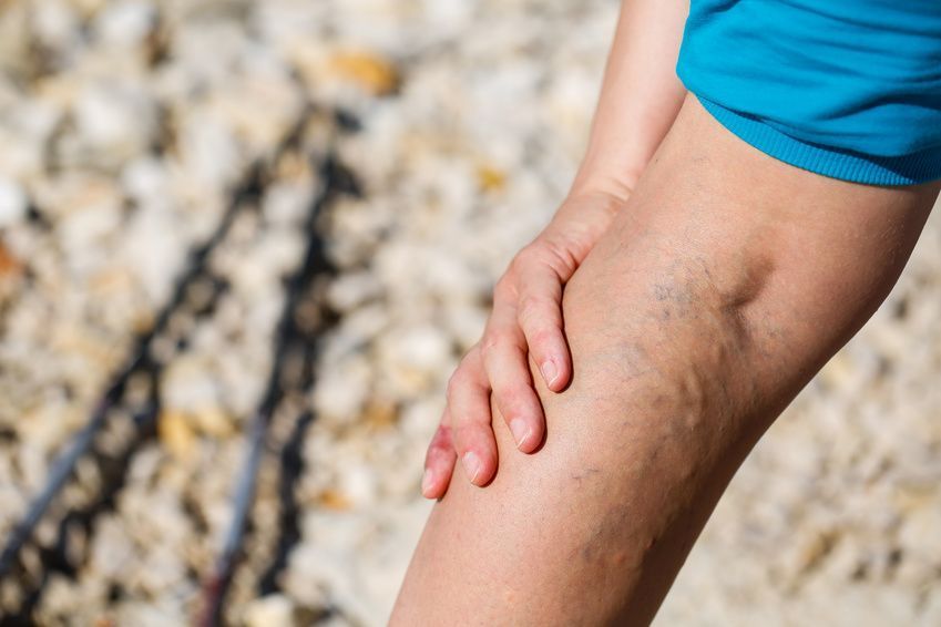 Bindegewebsschwäche Varicose veins develop when the connective tissue weakens.