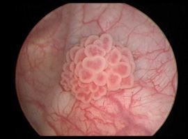 A biopsy of the bladder is performed before bladder cancer treatment.