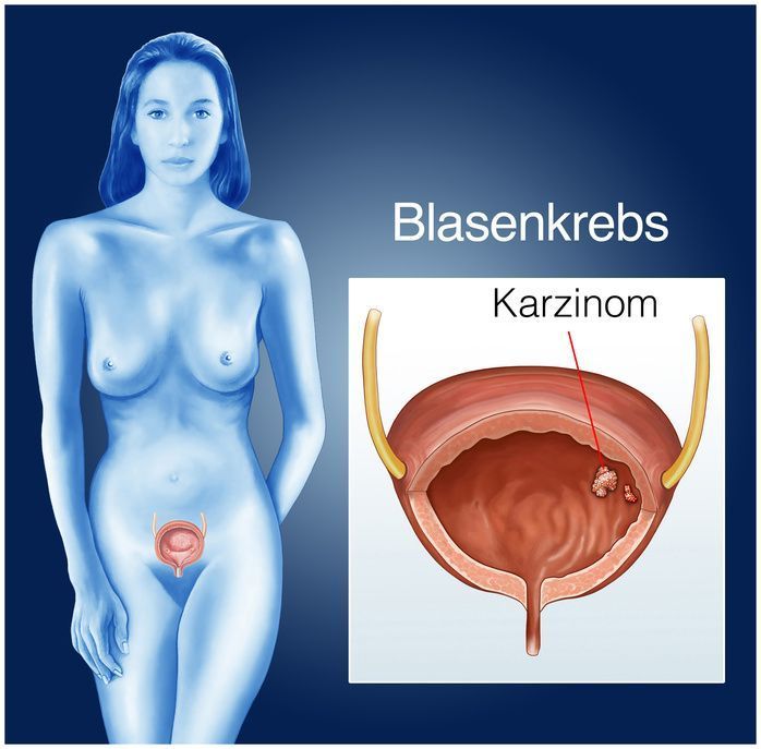 Bladder cancer usually develops unnoticed in women for a long time. Successful treatment is nevertheless possible under certain conditions.