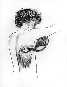 Breast reconstuction latissimus dorsi illustration