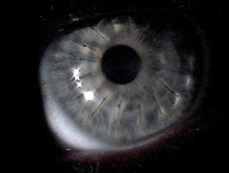 Corneal transplant