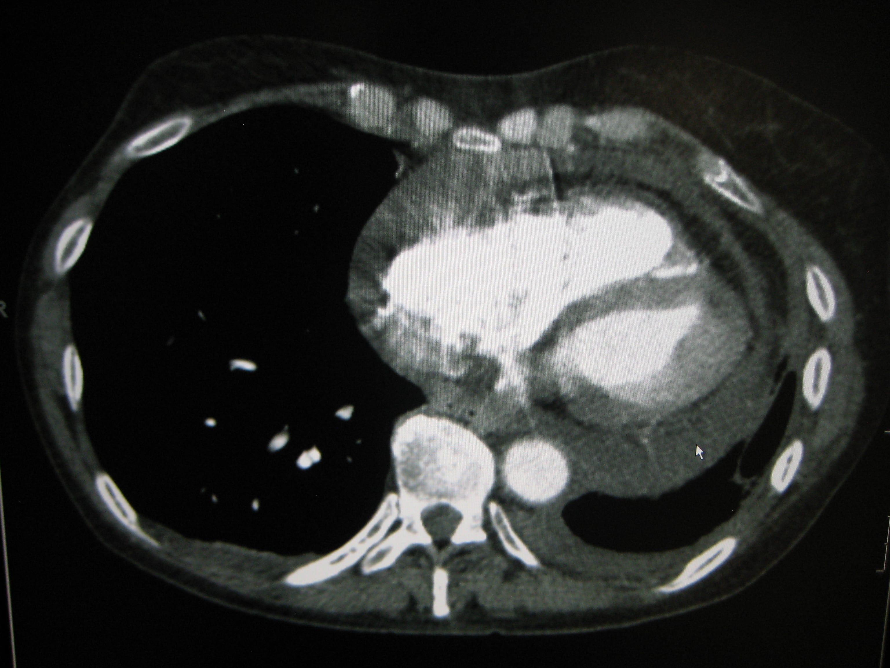 Pericardial effusion2009.JPG