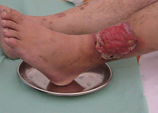 Type of leg ulcer