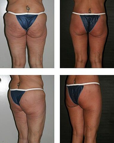 Dr. Placik Buttock Lift