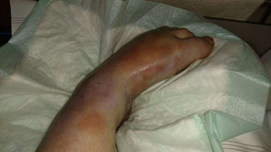 crps schmerzsyndrom fuss