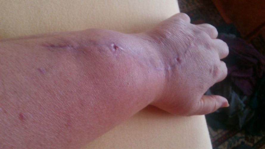 crps schmerzsyndrom hand