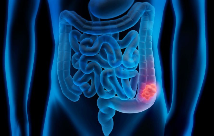 Darmkrebs Colon Cancer