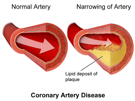 Blausen 0259 Coronary Artery Disease 02