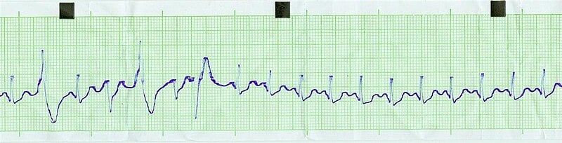 Ekg es tach bionerd.jpg