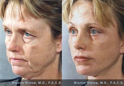Face Lift 01 Dr. Ristow