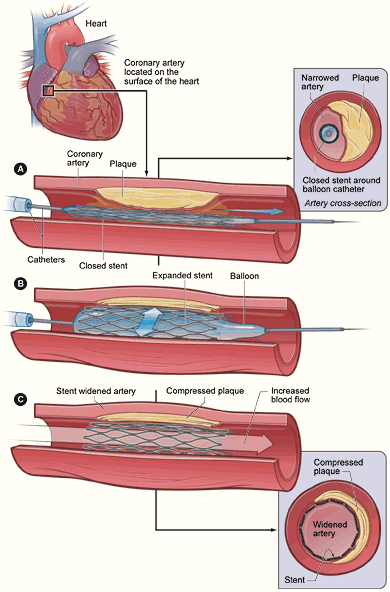 Treatment with a balloon catheter can reduce erectile dysfunction.
