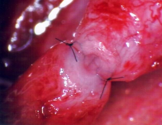 Vasovasostomie1 Βασοβασοστομία1