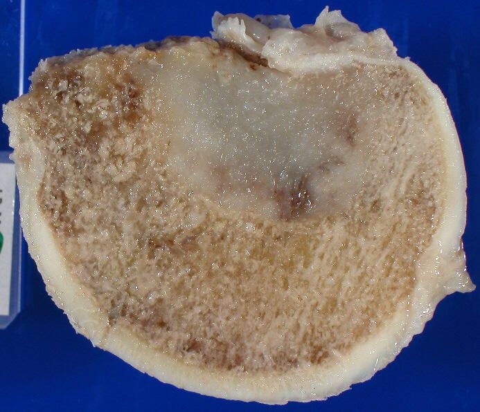 Femoral head with bone metastasis 02