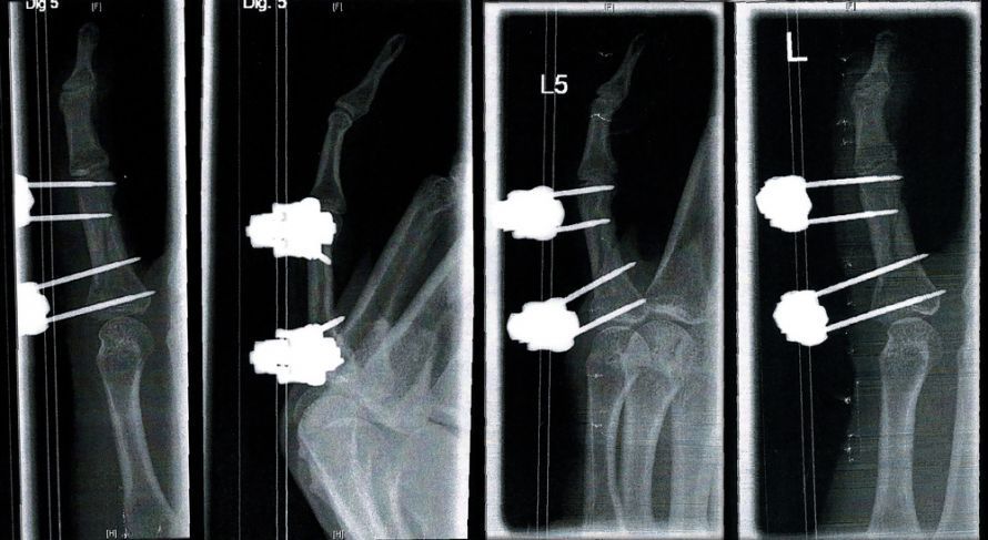 Finger gebrochen If a finger is broken, an X-ray helps with the diagnosis.