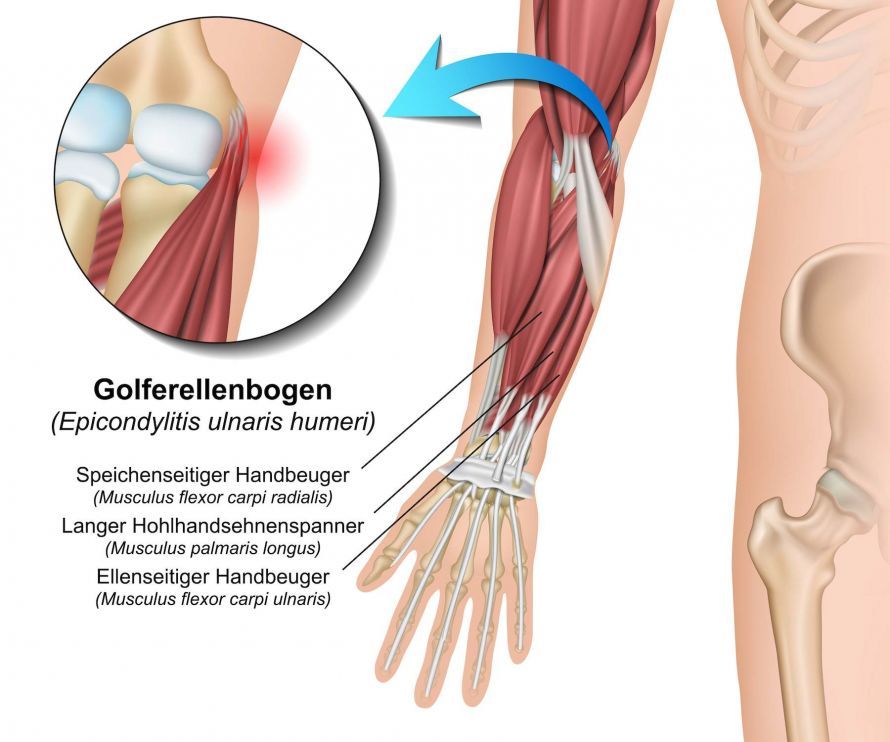 Golferellenbogen Golfer's Elbow