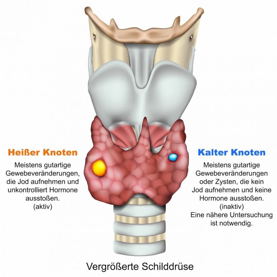 heiße und kalte Knoten - Schilddrüse heiße und kalte Knoten - Schilddrüse