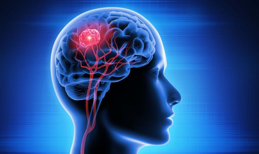 Hirntumor Όγκος στον εγκέφαλο