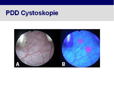 PDD Cystoskopie PDD Cystoskopie