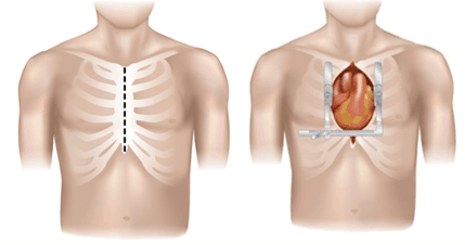 Klassische Sternotomie Conventional Sternotomy