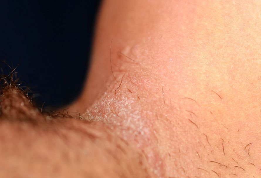 Jock itch tends to develop in dark, warm, and moist skin folds.