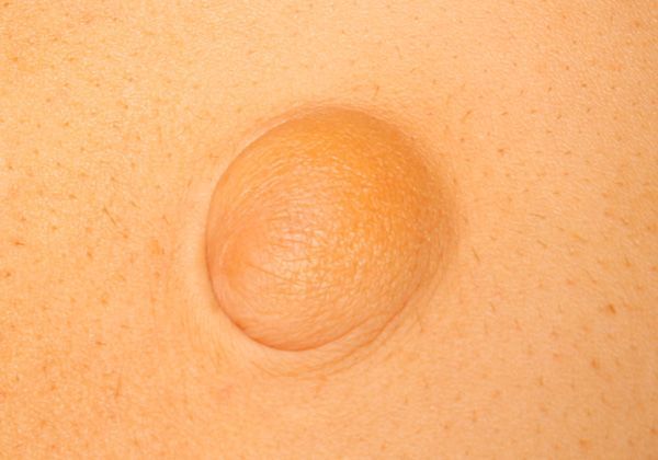Nabelhernie Frontalansicht Nabelhernie Frontalansicht