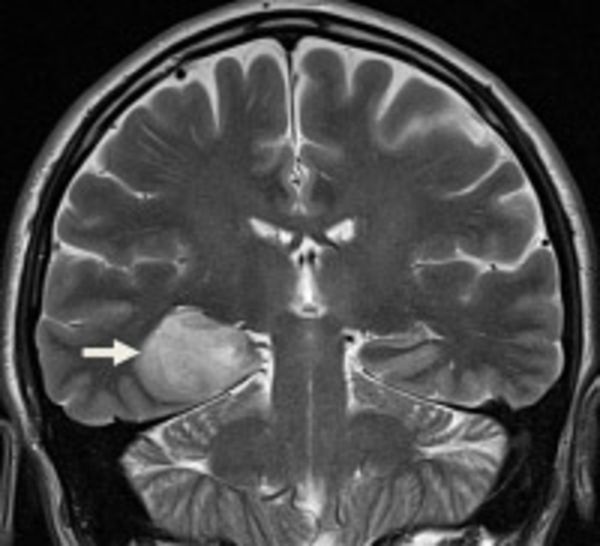 Astrozytom - MRT Diagnostik - Abb.1 Astrocytoma - MRI Diagnosis - Fig. 1