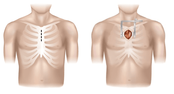 partielle Stenotomie partial stenotomy