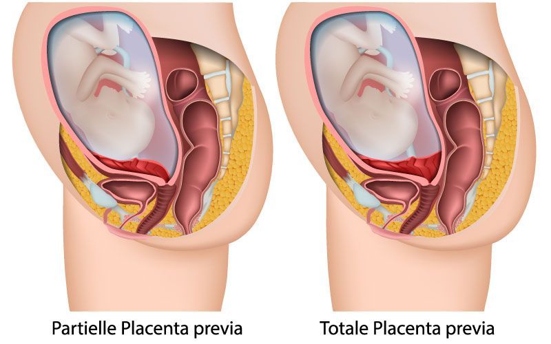 Plazentafehllagen Plazenta praevia Leading Medicine Guide Placental Abnormalities: Placenta Previa — Leading Medicine Guide