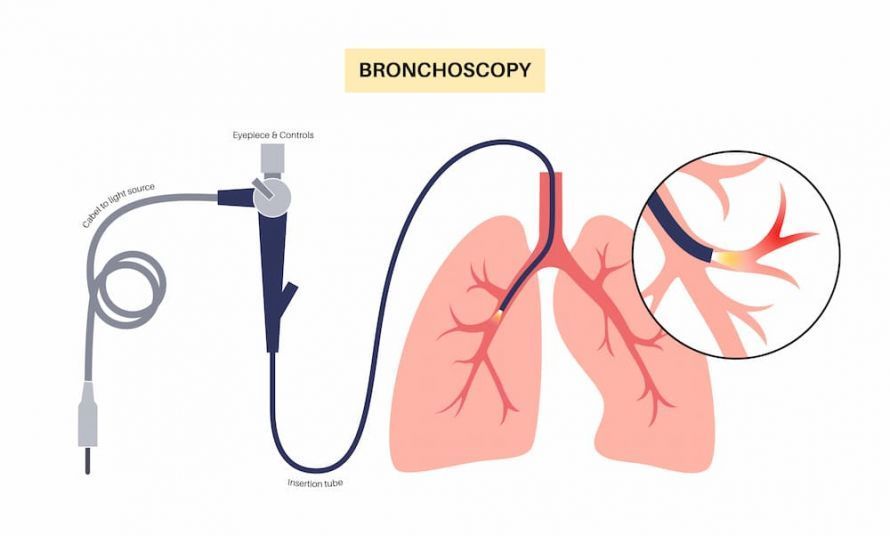 Die Bronchoskopie ist ein wichtiges Diagnoseverfahren der Pulmologie