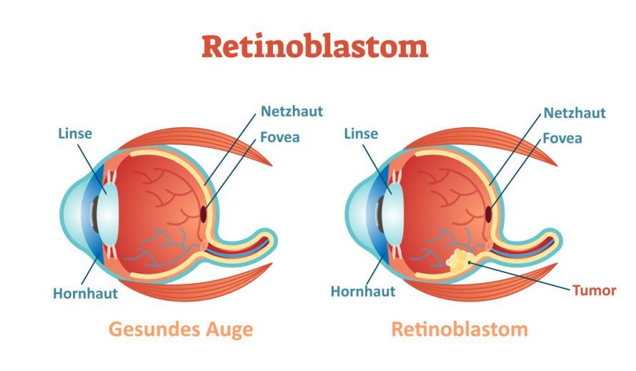 Retinoblastom Ρετινοβλάστωμα