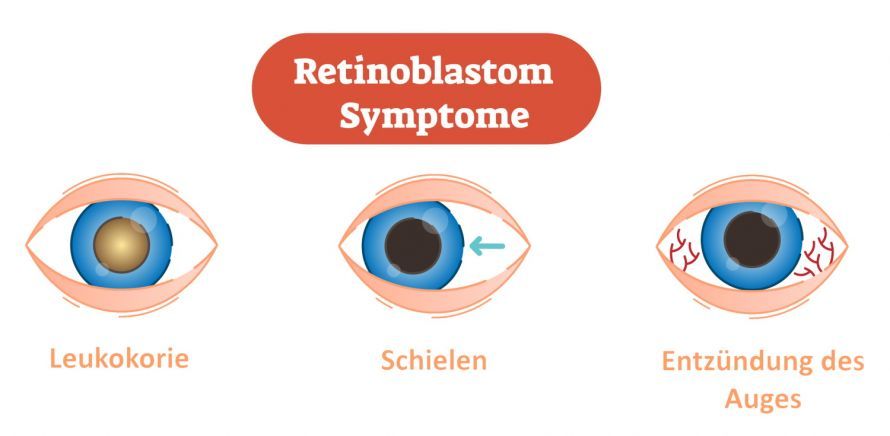 Retinoblastom Symptome Συμπτώματα του ρετινοβλαστώματος
