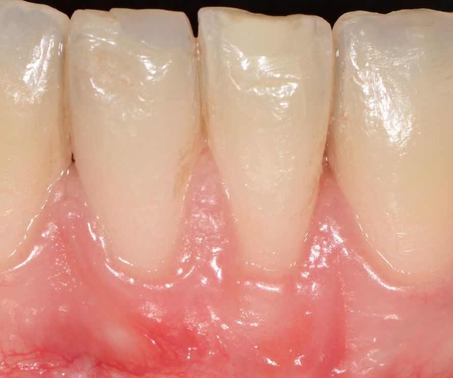 sculean4.jpg sculean4.jpg