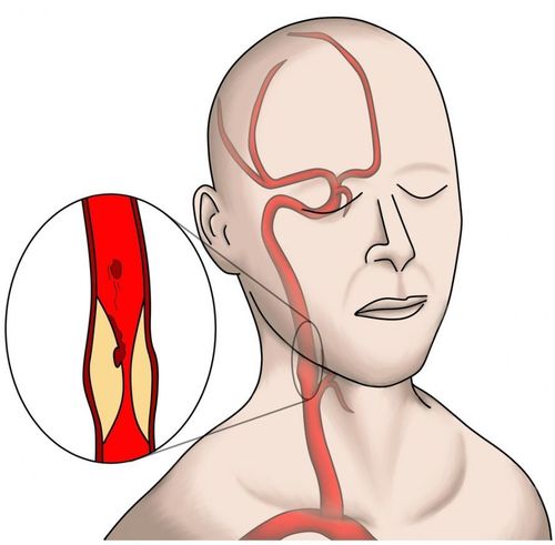Carotisstenose.jpg