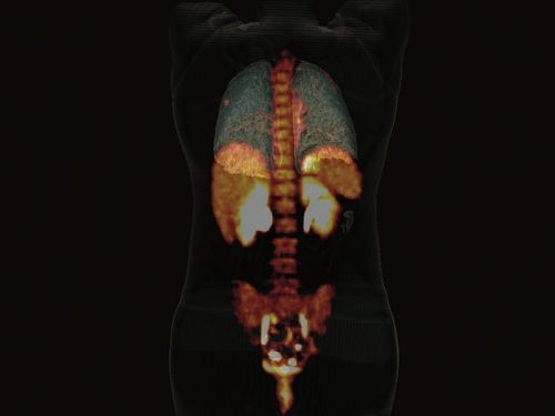 PET-CT_Biograph_Horizon_Untersuchung_Lunge_Siemens_Pressebild.jpg