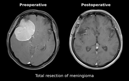 Total resection of meningioma