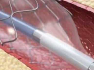 stent.jpg