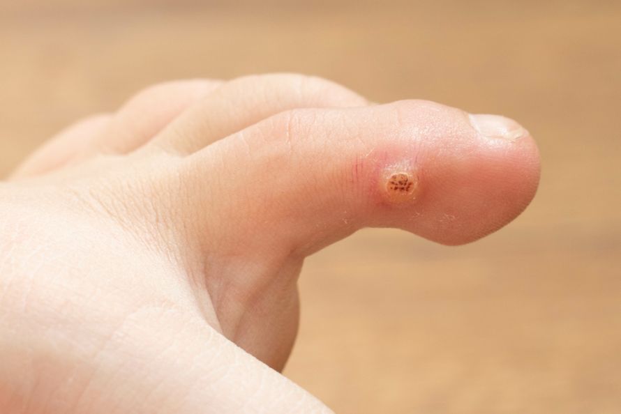 There are several ways to remove a wart on your foot