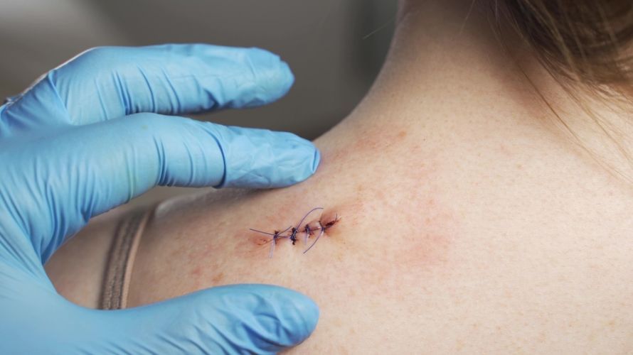 Wound after wart removal