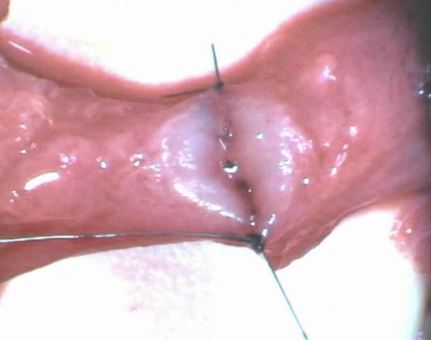 Vasovasostomie2 Βασοβασοστομία2
